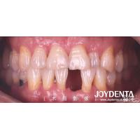 Buy cheap Customizable Dental Maryland Resin Bonded Bridges for Anterior And Premolar product