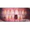 Buy cheap Customizable Dental Maryland Resin Bonded Bridges for Anterior And Premolar Teeth from wholesalers