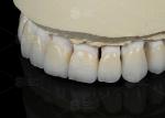 Natural Tooth Color Ceramic Feldspathic Veneer For Anterior And Posterior Teeth