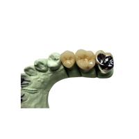 Buy cheap High Biocompatibility PFM Crown Porcelain Fused For Back Teeth Restoration product