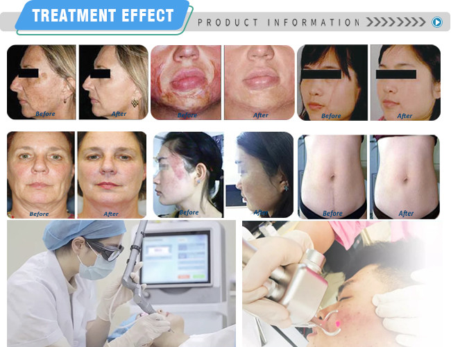 Scar Removal Co2 Laser Resurfacing Machine Equipment Home Use Rejuvenation Vaginal