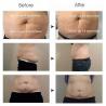 Buy cheap Super product standing cool slimming cellulite reduction cool tech fat freezing slimming criolipolisis machine from wholesalers