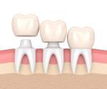 Beautiful Dental Crowns And Bridges Smooth Surface For Oral Hygiene Safety