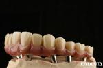 Titanium Malong Dental Hybrid Bridge Long Lasting Adjusted Fit Low Density