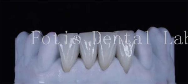 Buy cheap Thin Synthetic Laminate Veneer Teeth 0.3-0.5mm Thick Beautiful Looking from wholesalers