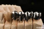 Oral Clinical Repair FMC Full Metal Crown Made With Wax Casting Production