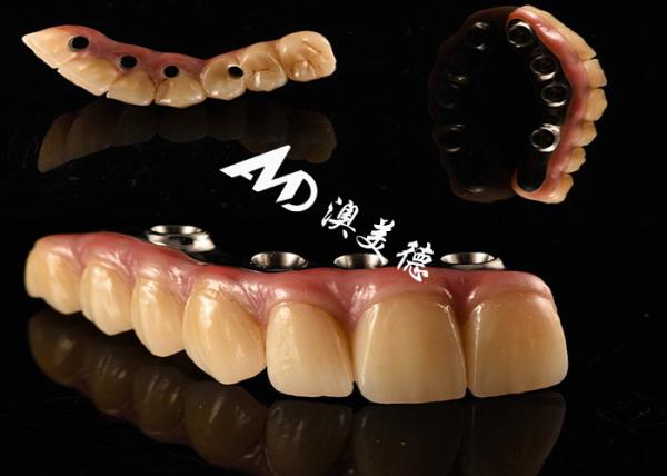 Natural Looking Dental Implant Crown bridge Fixed with Titanium abutment for