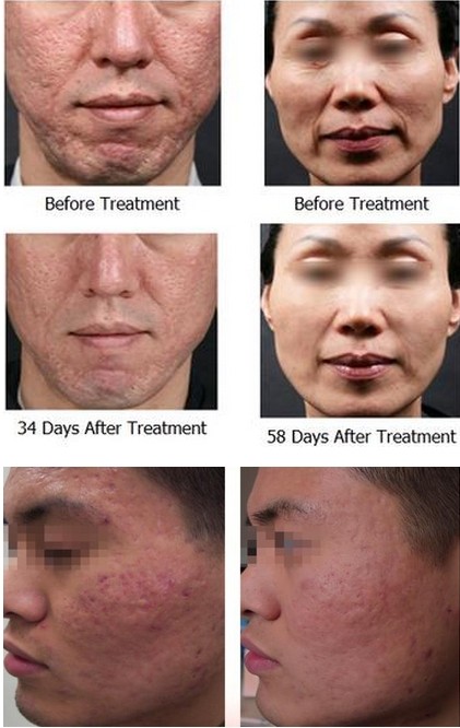 Minimal Invasive Fractional Rf Microneedle , Multi-Function Beauty Equipment