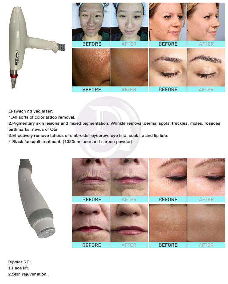 Multifunction 4 in 1 Elight ipl opt rf nd Yag Laser Tattoo Removal IPL Hair Removal Beauty Machine