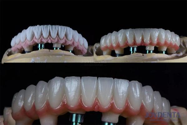 Buy cheap 10mm Multiple Teeth Two Stage Dental Implant Kit For Endosseous Prosthetic Crown from wholesalers