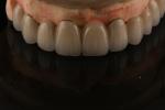 PFM Porcelain Fused to Metal Crowns and Bridges Seamless Bonding for Natural