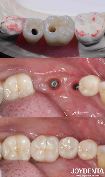 Buy cheap Cylindrical All On 4 Titanium Dental Implants 10-16mm Length Hex Connection from wholesalers