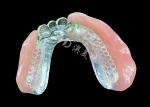 Enhance Your Smile Natural-looking PFM Crown bridge and Removable Dentures Combo