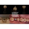 Buy cheap Ultra Hard Colour Stability Dental Implant Crown OEM Easy Maintain Long Lasting from wholesalers