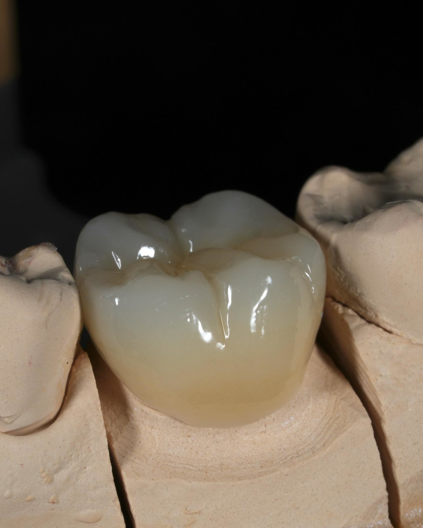 Full Contour Zirconia Crown Quick Turnaround for Precise and Aesthetic Fit in 1 Week