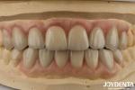 High Translucency Emax Cosmetic Dentistry Veneers High Aesthetics Ultra Thin