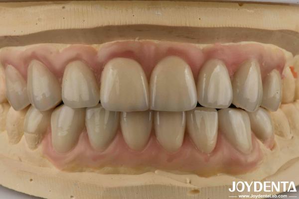 Buy cheap High Translucency Emax Cosmetic Dentistry Veneers High Aesthetics Ultra Thin from wholesalers