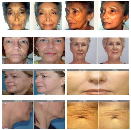 Fractional RF Skin Tightening Machine With CE For Wrinkle Removal (NBW-R400)
