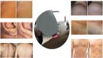 10.4 inch Touch Screen Painless Diode Laser Hair Removal Machine