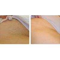 Buy cheap Profession hair removal portable 808nm diode laser hair removal machine product