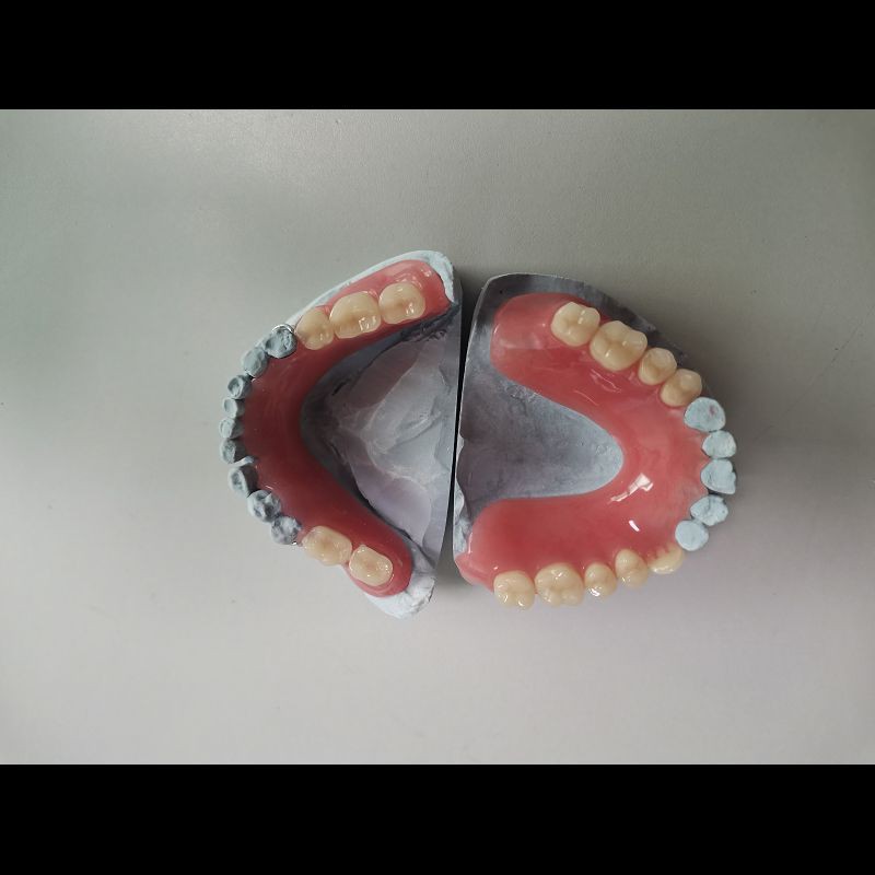 Custom Made Acrylic Removable Partial Denture Single Tooth