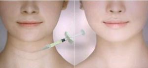 Buy cheap Achieve Plumper Lips With Dermal Lip Fillers Neck Lines Filling Face Wrinkles Filler from wholesalers