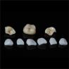 Buy cheap Dental Restorations IPS EMax Inlay Onlay All Porcelain Highly Durable from wholesalers