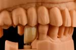 Internal Hex Connection Sandblasted Titanium Dental Implants Single Tooth