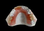 Partial Removable Denture , removable dental prosthesis For Chewing And Speaking