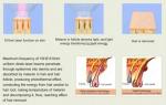 808nm Diode Laser Hair Removal Machine Permanent For Men Or Women