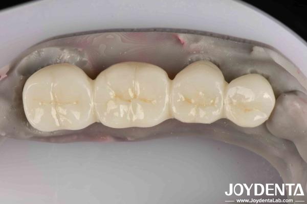 Excellent White Product Full Zirconia With High Resistance To Corrosion