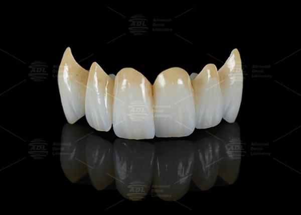 Buy cheap High Translucency Full Contour Zirconia Bridge Chipping Resistance Natural Esthetics from wholesalers