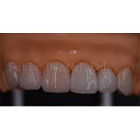 Buy cheap 3 Shape Digital Crowns Good Compatibility Dentrues Design 1 Day Delivery product