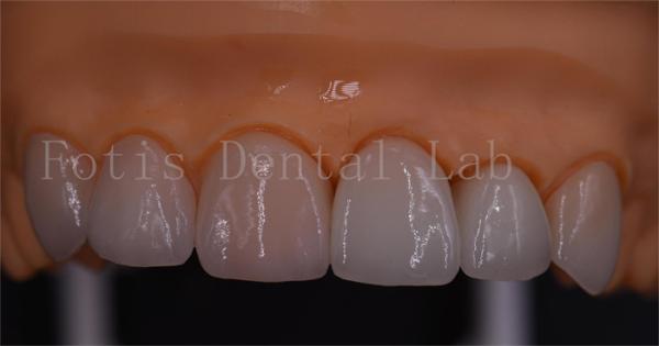 Buy cheap 3 Shape Digital Crowns Good Compatibility Dentrues Design 1 Day Delivery from wholesalers