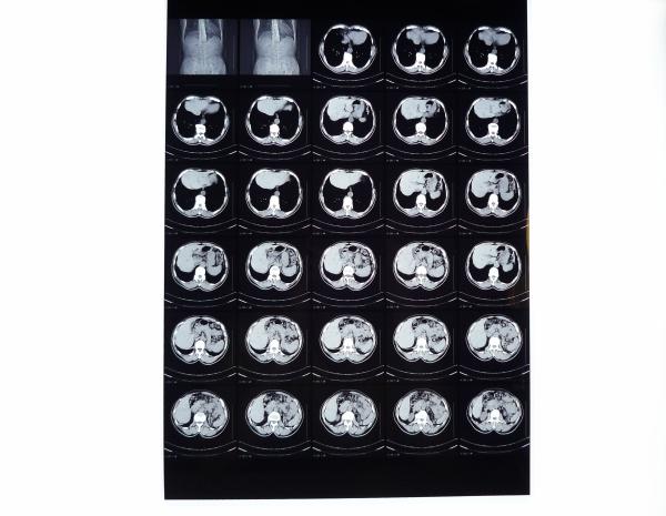 8in x 10in High Density Medical Dry Film For Fuji DRYPIX 3000 / 2000 / 1000