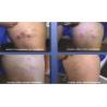 Buy cheap Totally painless 30Mhz painfree RBS laser spider veins laser removal machine from wholesalers