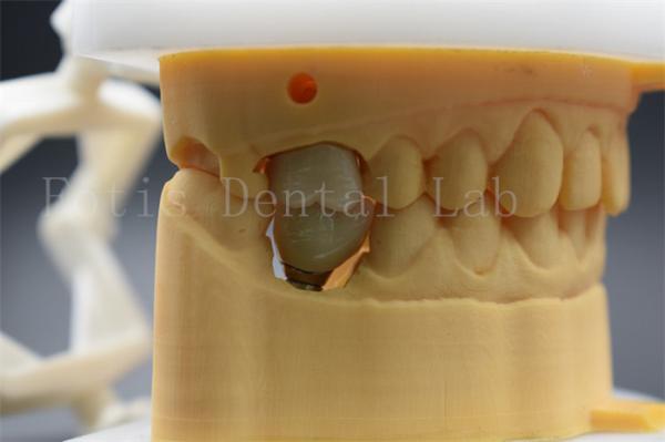 Buy cheap Customizable Dental Implant Abutment Crown Comfortable For Patients from wholesalers