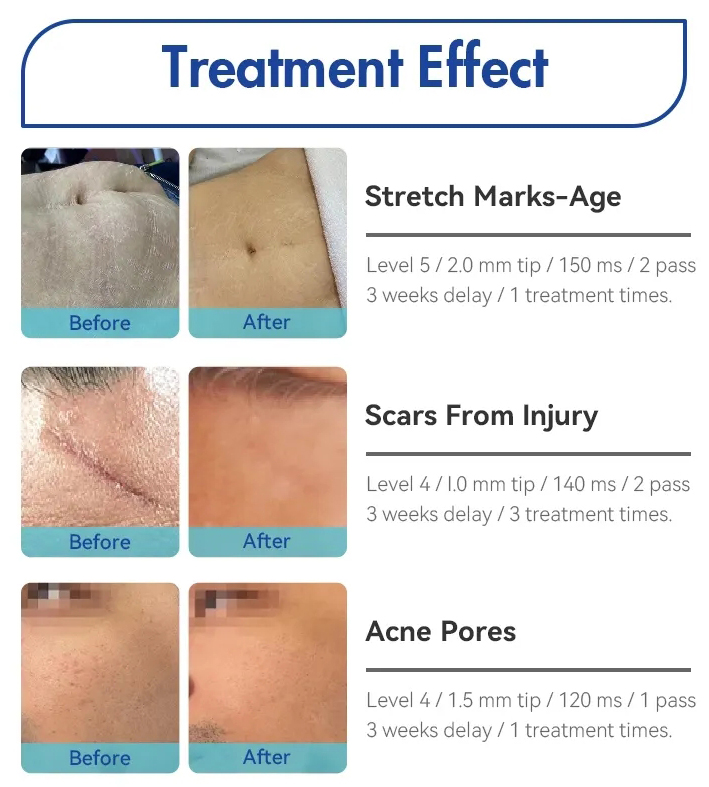 Wrinkle Removal Secret RF Machine