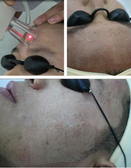 Buy cheap Best Selling products medical laser vaginal tightening fractional co2 tube fractional from wholesalers