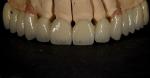 Good Fitting Good Esthetics Multi Layered Zirconia Crown Porcelain Zirconia