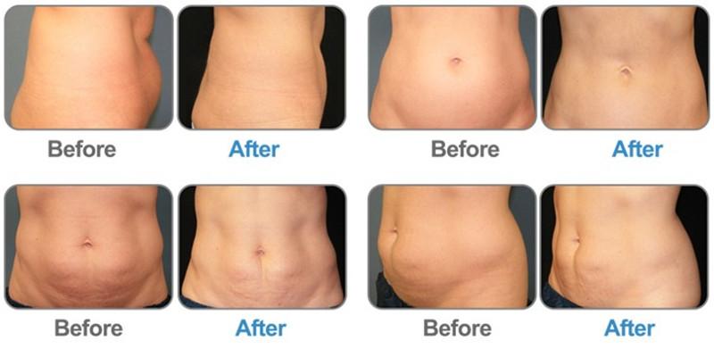 20Hz Cryolipolysis Fat Freezing Machine With EMS Muscle Stimulate