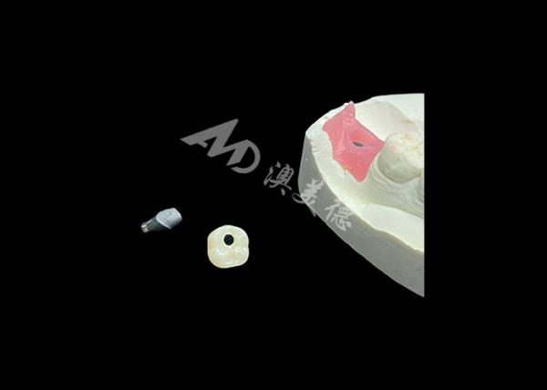 Buy cheap Long-lasting Dental Implant Crowns Revolutionizing Restorative Dentistry Procedure from wholesalers