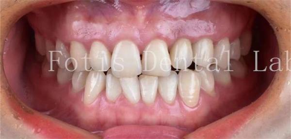 Buy cheap Cosmetic Dentistry Dental Porcelain Veneers With High Stain Resistance from wholesalers