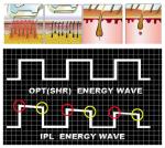 shr ipl beauty machine,ipl-skin-rejuvenation,pain free hair removal ipl! ipl shr