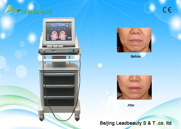 Buy cheap Beauty salon & clinic hot selling portable face lifting anti-wrikle HIFU machine from wholesalers