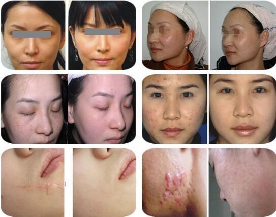 High Quality USA RF Tube fractional co2 laser skin resurfacing for scar removal