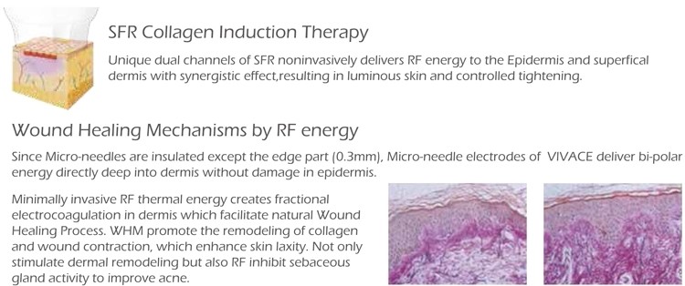 Nubway New Arrival!!! Fractional rf microneedle skin rejuvenation ce approved rf fractional micro needle machine