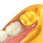 Biocompatible Invisible Denture Base Resin Dental Resin