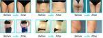LEADBEAUTY Body Contouring Slimming Machine in promotion