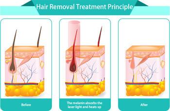 Buy cheap CE approved new laser diode 808nm products laser hair removal training Nubway 808 diode laser for sale from wholesalers